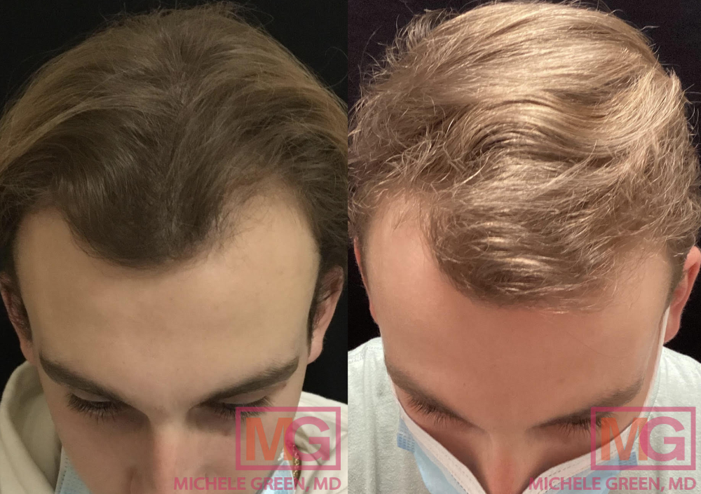 JA Before and after 3 PRP treatment sessions 4 months apart FRONT MGWatermark