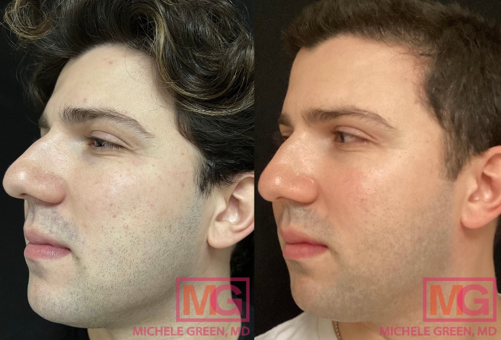 Restylane filler before and after
