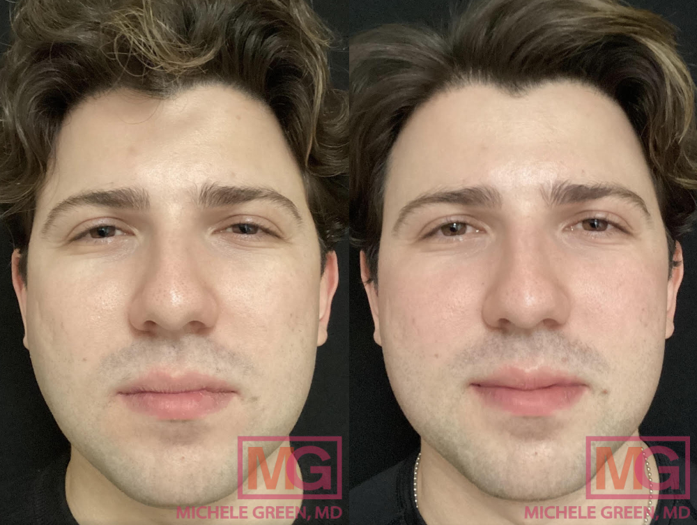 JC 26 yo male before after Voluma cheeks 15 days apart MGWatermark