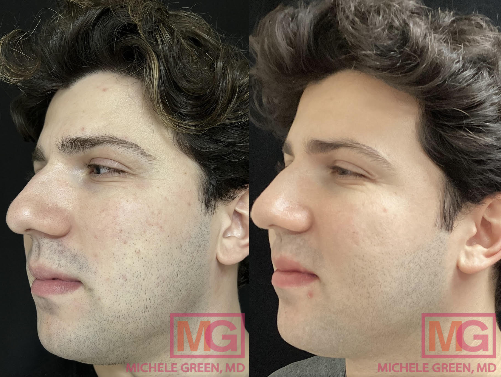 JC 26yo male before and after Fraxel x3 and Restylane x1 for acne scars 8 months PROFILE L MGWatermark