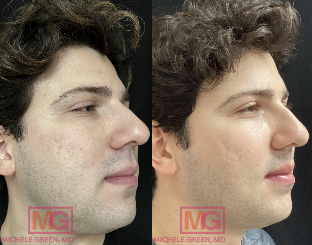 JC 26yo male before and after Fraxel x3 and Restylane x1 for acne scars 8 months PROFILE R MGWatermark