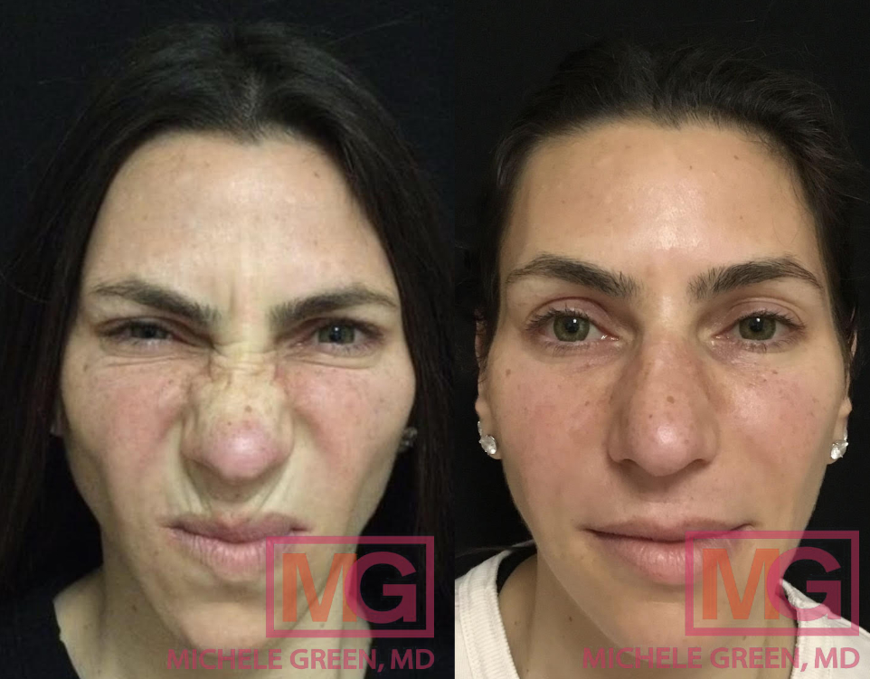 female before and after botox forehead, glabella, and eyes