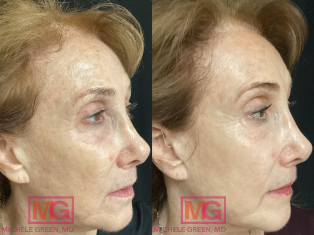 Before and After Fraxel and AlexTrivantage