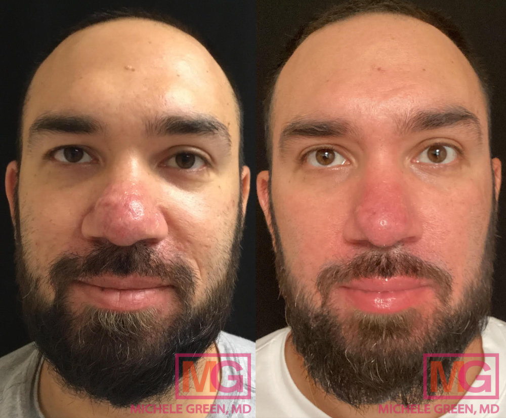 Before and after acne and VBeam treatment