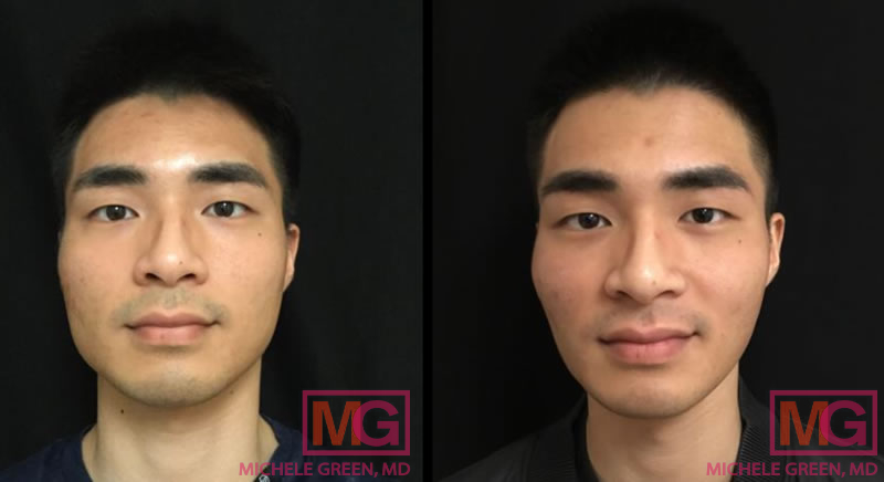 18-24 year old male. Botox to masseter muscle, 3 months before and after