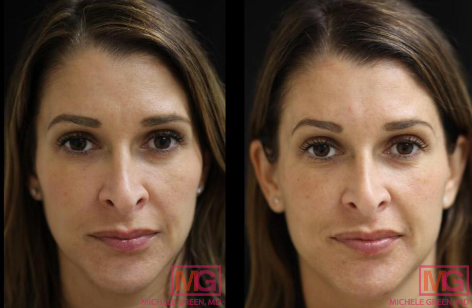 Restylane one syringe nasolabial area and Botox in forehead