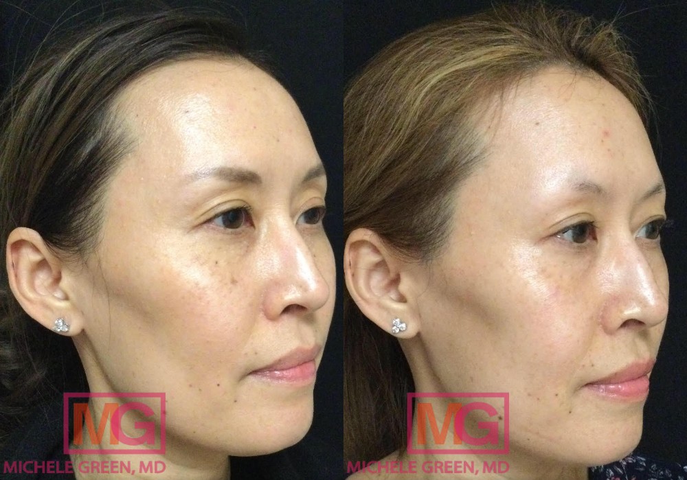 JM 42yo female before after sun spot treatment with Alex trivantage MGWatermark 1