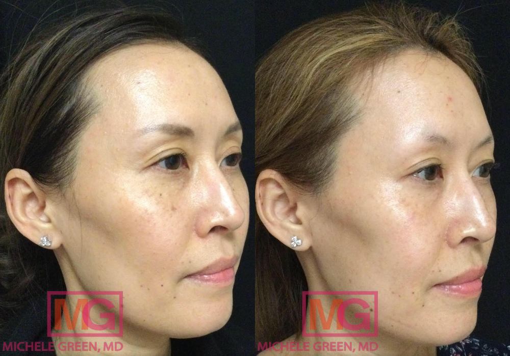 42 year old female before and after sun spot treatment with alex trivantage