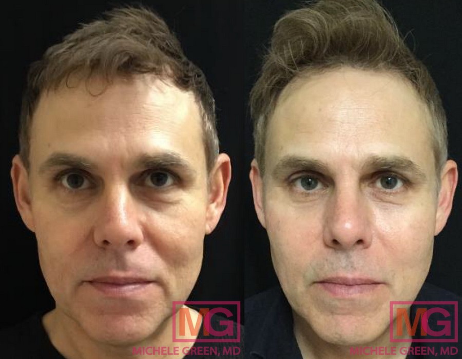 JM 57yr old Sculptra 3 treatments 2 eMatrix for acne scars and one syringe of Restylane for Nasolabial area MGWatermark 1