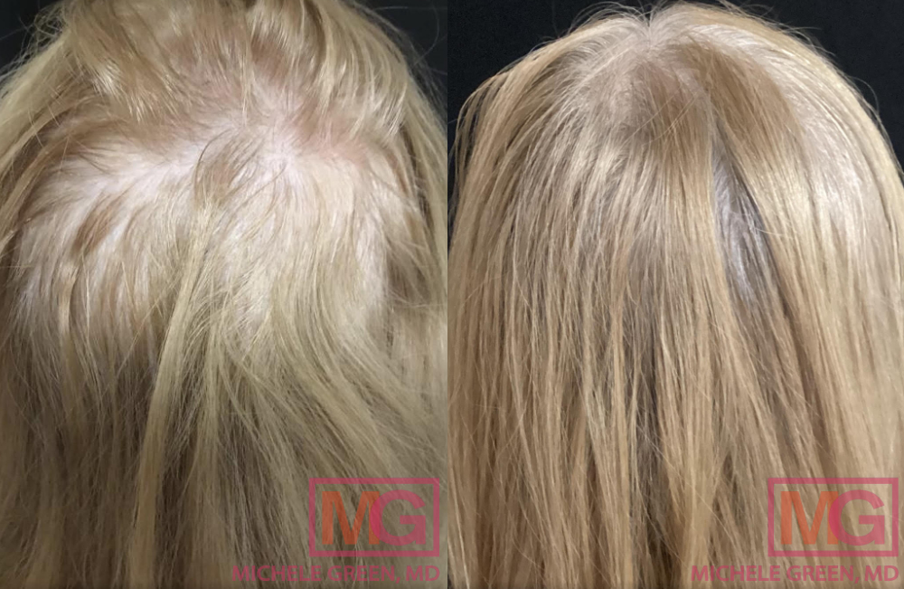 JM 63yo female before and after PRP x4 6 months BACK 1 MGWatermark