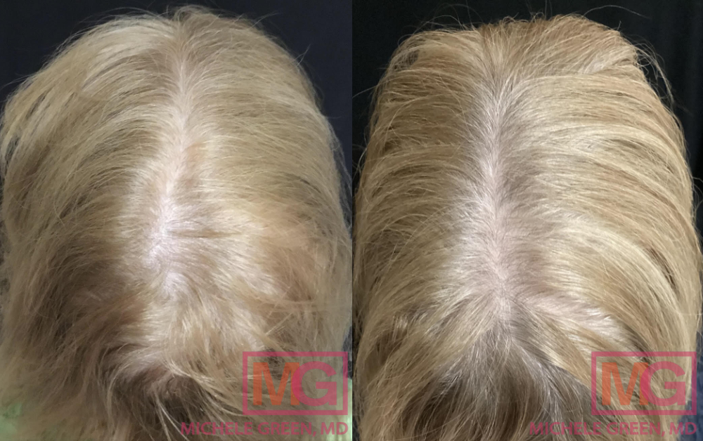 JM 63yo female before and after PRP x4 6 months BACK 2 MGWatermark