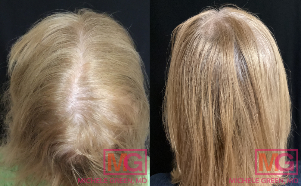 JM 64 year old before after PRP hair treatment MGWatermark