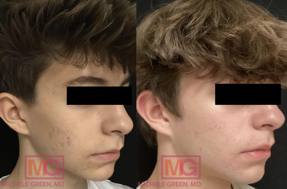 JO 15 yo male before and after acne treatment photos 1 year and 3 months apart RIGHT MGWatermark