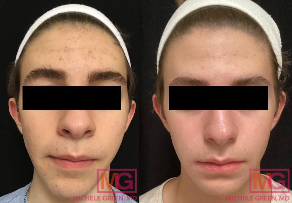 16 year old female, before and after Accutane