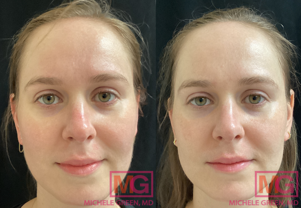 JO 28 yr old before after Vbeam laser for Rosacea MGWatermark