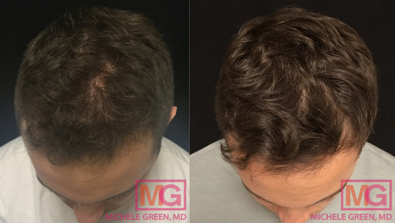 6 months PRP Treatment Before and after