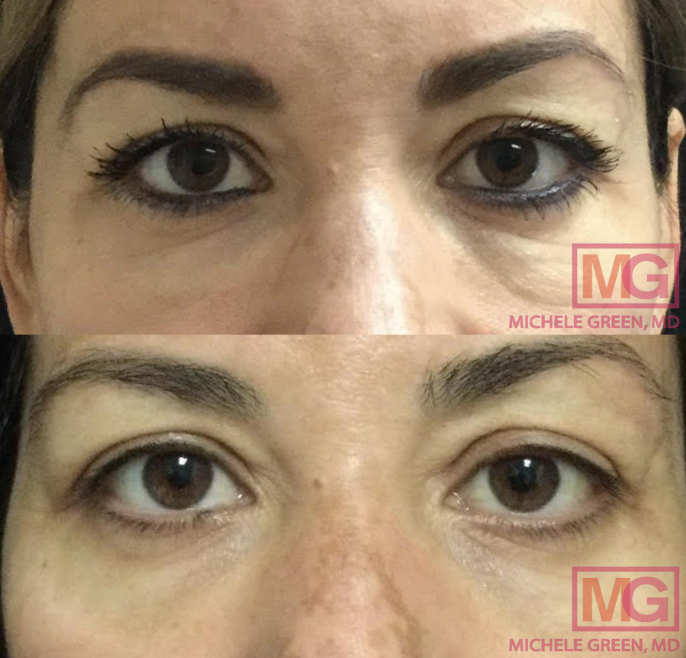 JS 47yo f before and after Hyaluronidase 2weeks after undereyes Front MGWatermark