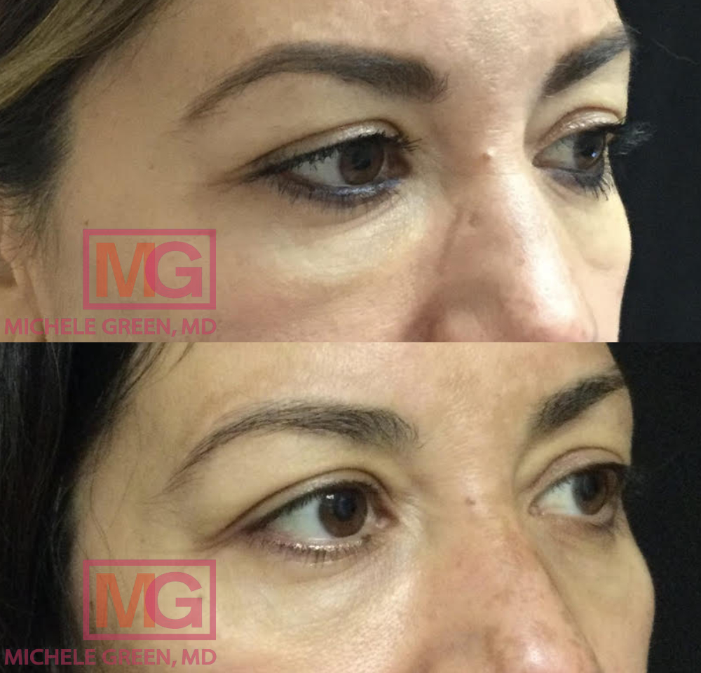 JS 47yo f before and after Hyaluronidase 2weeks after undereyes undereyes AngleR MGWatermark