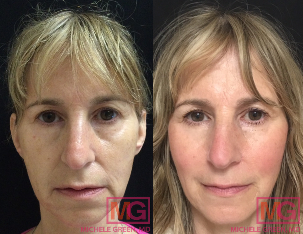 55 year old before & after Restylane