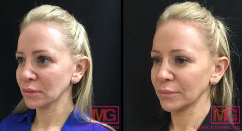 40-45 year old, Botox and Fraxel for wrinkles and sun damage