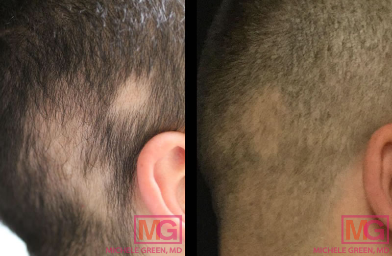 Male treated with steroid injections for Alopecia Areata – 6 Treatments