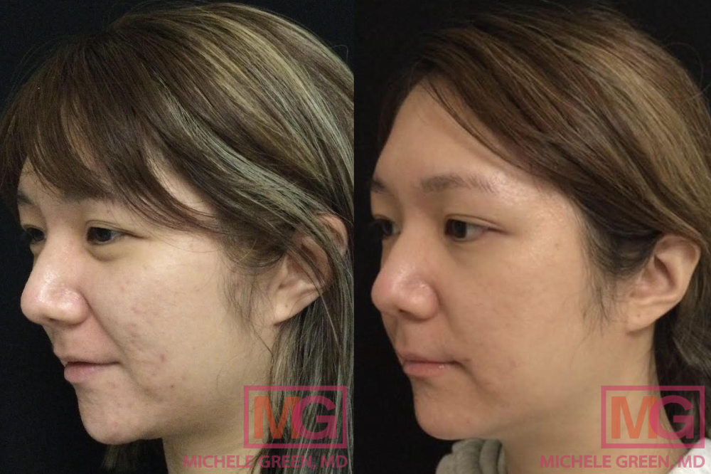 JYZ 28 yo female before and after acne treatment LEFT MGWatermark