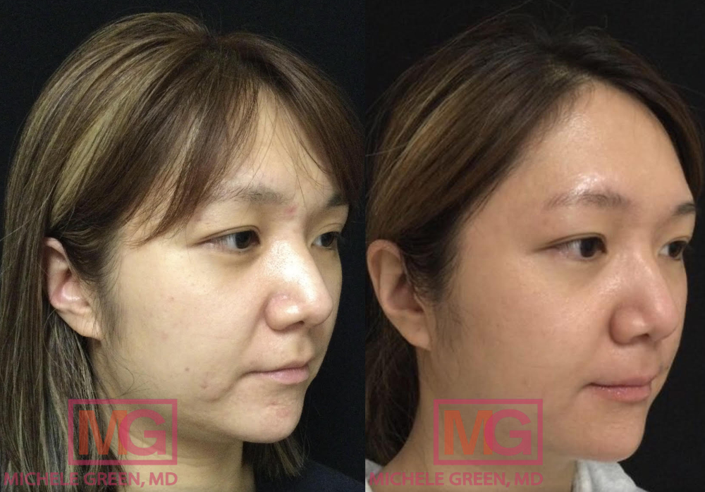 JYZ 28 yo female before and after acne treatment RIGHT MGWatermark