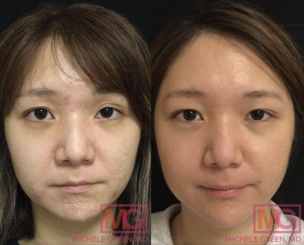 28 year old female, acne treatment - 1 month