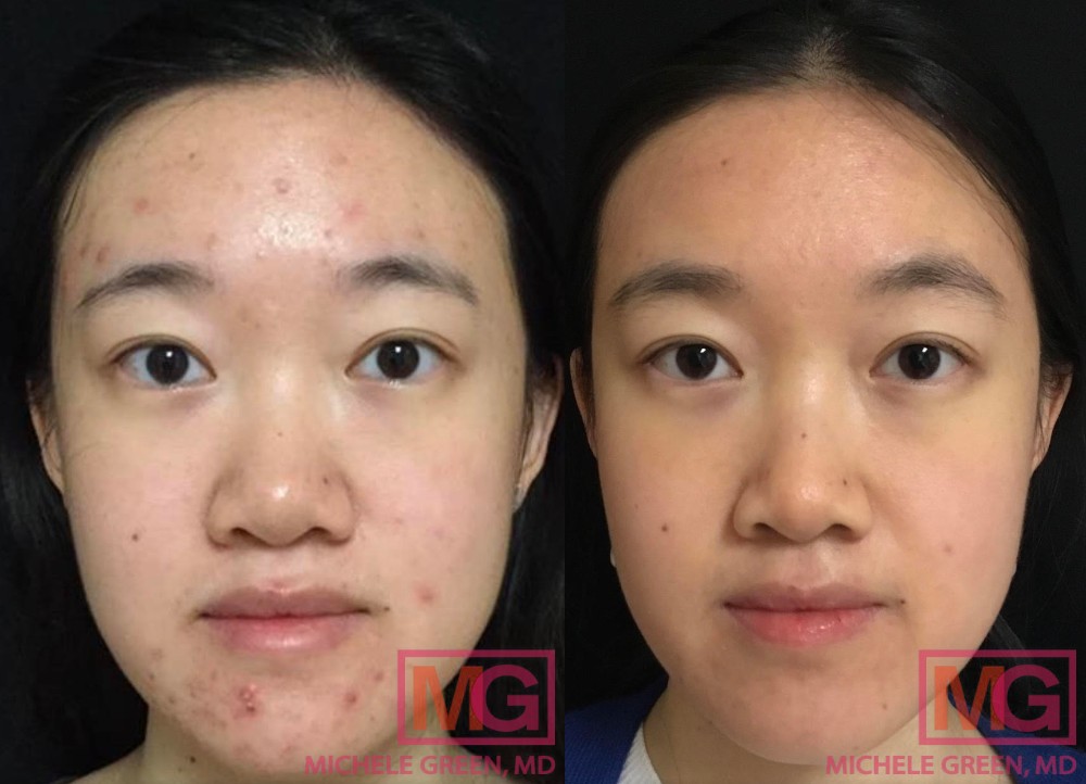 JZ 25 F before and after 6 months of Accutane FRONT MGWatermark 1
