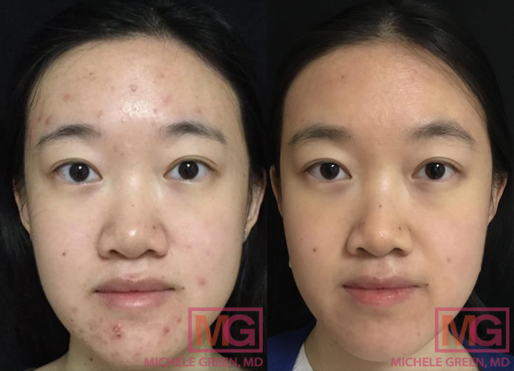 JZ 25 F before and after 6 months of Accutane FRONT MGWatermark