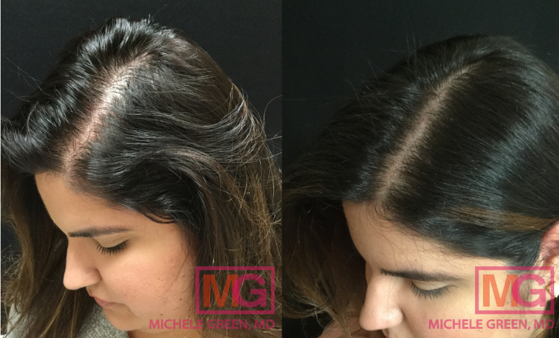 KC 37 Before and After PRP Hair 2 sessions 6 months LEFT MGWatermark