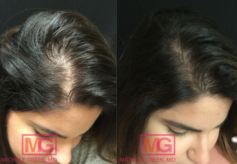 KC 37 Before and After PRP Hair 2 sessions 6 months MGWatermark