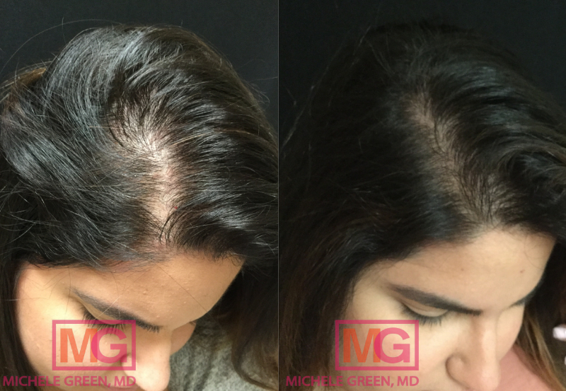 Oral Minoxidil for Hair Loss, Treatment for Hair Loss & Balding