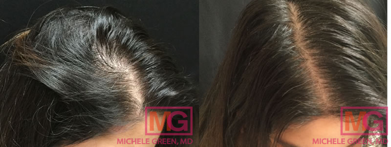 PRP Hair Loss Before & After Photos, Male & Female, Platelet Rich Plasma  for Hair