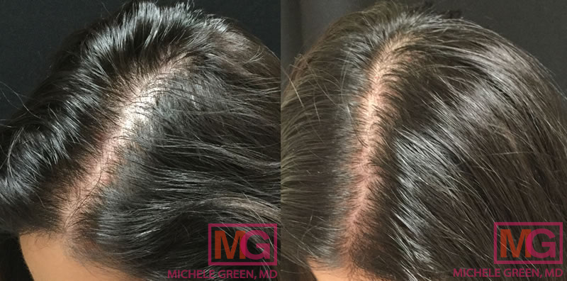 34 year old female, PRP to scalp for hair loss – after 3 treatments