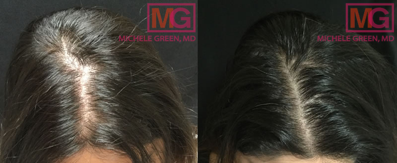 34 year old female, PRP to scalp for hair loss – after 3 treatments