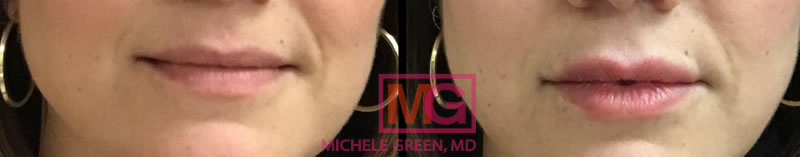 KC lip injections restylane 1 before after LIPS MGwatermark