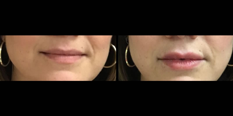 KC lip injections restylane 1 before after LIPS SQ