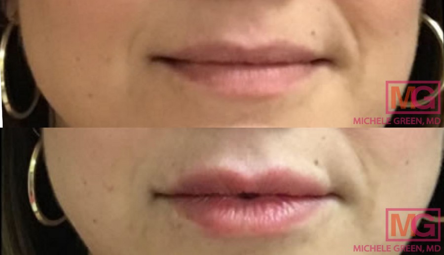 Female treated with Restylane in Nasolabial folds