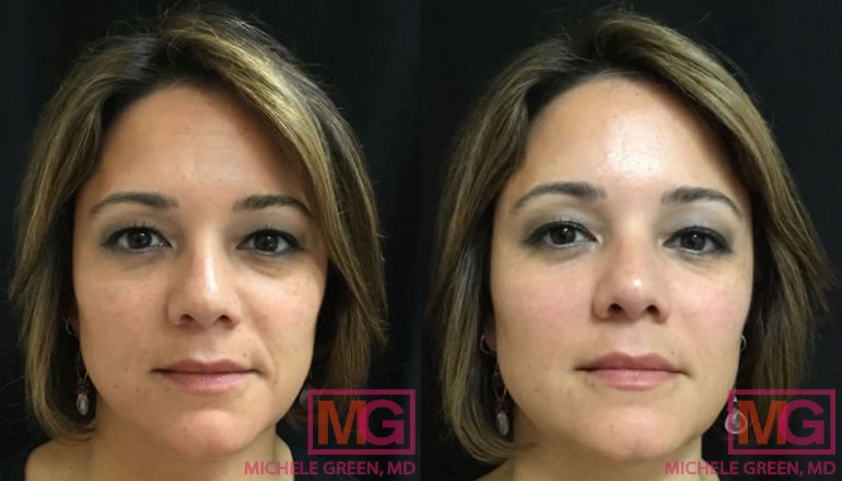 Female treated with Restylane in Nasolabial folds