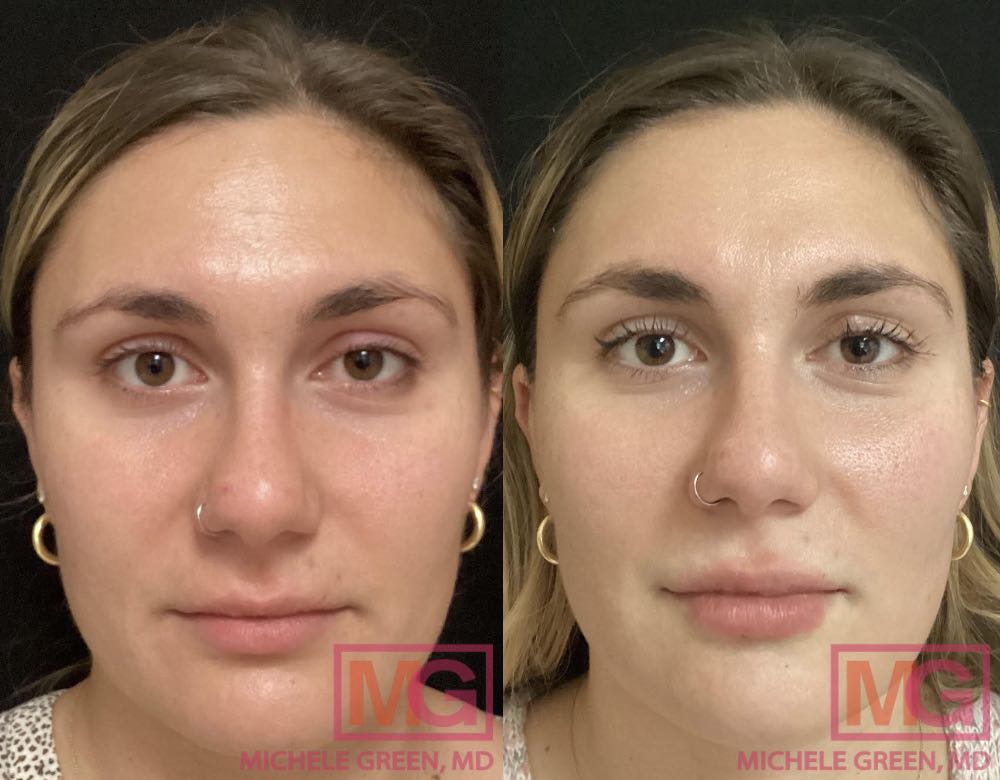 Juvederm Ultra Plus injections in lips before and after - 2 weeks