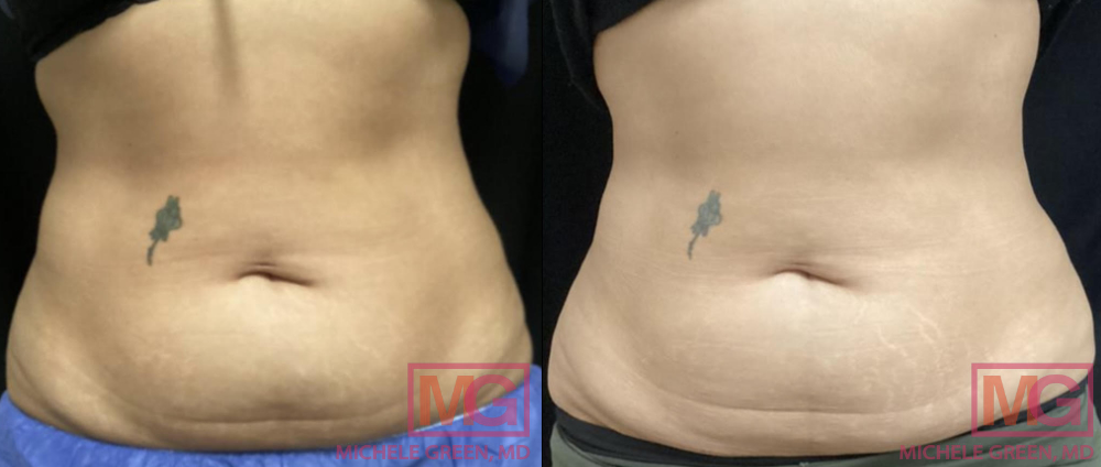 CoolSculpting Fat Freezing Abdomen