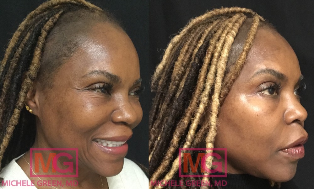 L.F 61 year old female 2 weeks Before and After Botox Crowsfeet MGWatermark