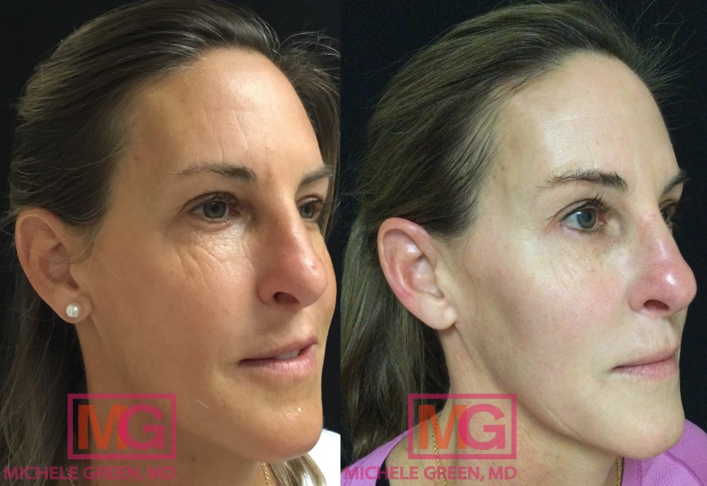 L.H 3 weeks Before and After JuvedermVoluma Cheeks 1 syringe UltraPlus NL 1 syringe MGWatermark