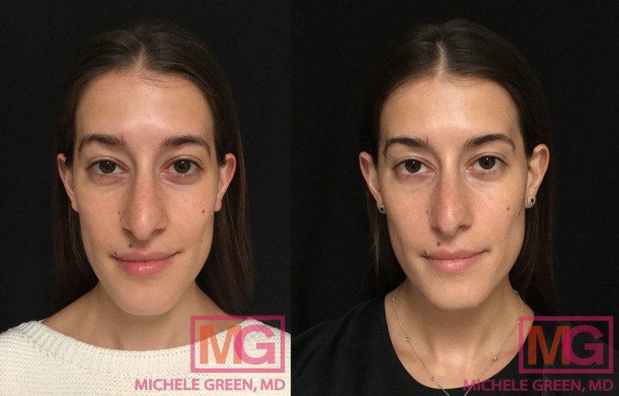35-44 year old - 1 month before and after Restylane under eyes