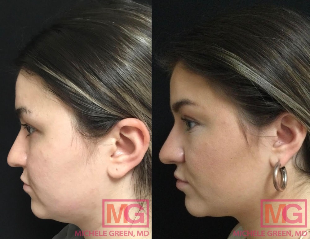 L.T. Before after 2 sessions Kybella MGWatermark