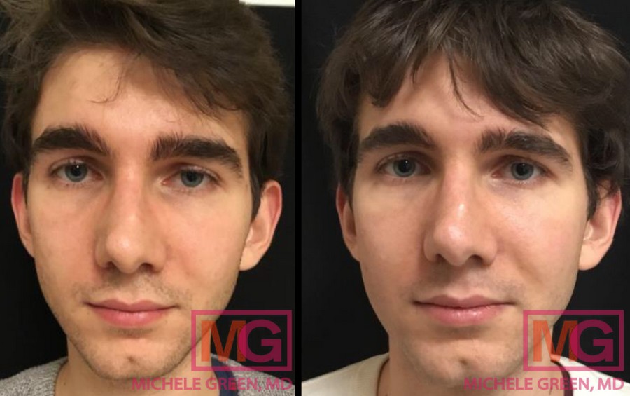 L.U 25 yr old male Before After Fraxel Laser correction 3 Fraxel treatmentsFRONT MGWatermark