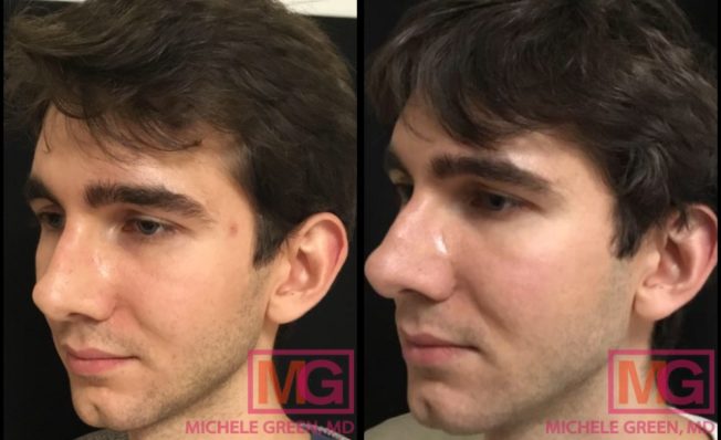 Wrinkles Begone! Check Out These Fraxel Laser Before & After Photos! - p0o8n8y
