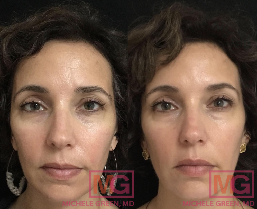 LC 47 yo f before and after Botox forehead glabella and eyes front MGWatermark