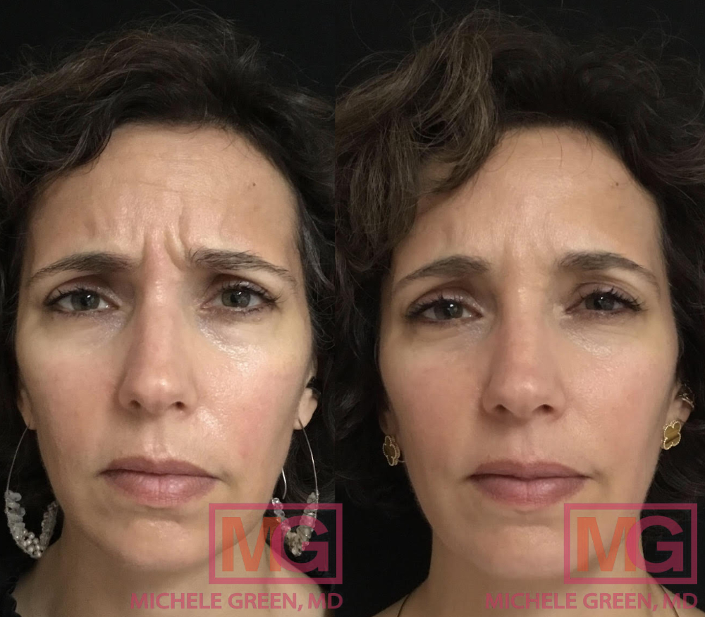 LC 47 yo f before and after Botox forehead glabella and eyes front3 MGWatermark